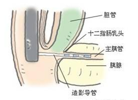 膽管炎性狹窄