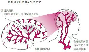 短暫性腦缺血發作