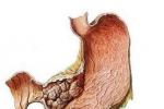 胃腸道間質瘤