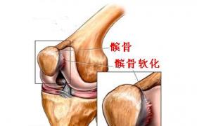 髕骨軟化癥