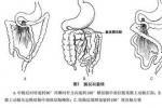 先天性腸旋轉不良