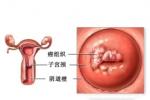 生殖道腫瘤