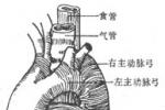 先天性主動脈弓畸形