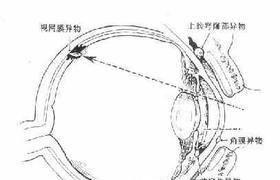 眼異物傷