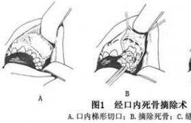 化膿性頜骨骨髓炎