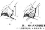 化膿性頜骨骨髓炎