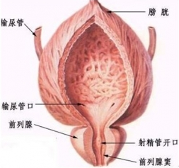 膀胱結石