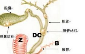 膽管癌