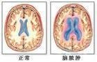 小兒硬腦膜外膿腫