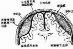 小兒硬腦膜外膿腫