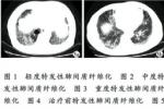 特發性肺纖維化