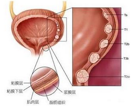 泄殖腔外翻