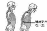 強直性脊柱炎