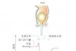 肛管內括約肌痙攣性收縮