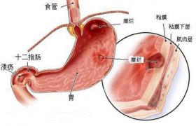 急性胃粘膜病變