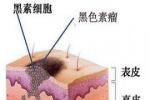 外陰黑色素瘤