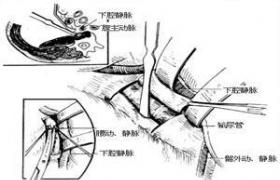 椎管內腫瘤