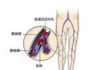 原發性下肢深靜脈瓣膜關閉不全