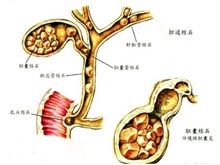 膽石癥