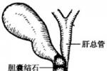 膽石癥