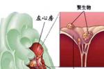 感染性心內膜炎