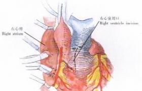 肺動脈高壓