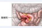 腸梗阻
