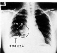 肺部良性腫瘤