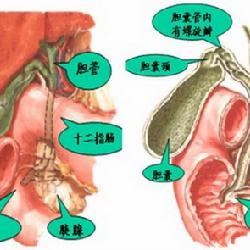 膽囊憩室