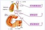 膽囊憩室