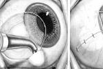 眼內轉移性腫瘤