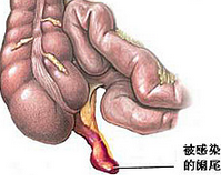 急性闌尾炎