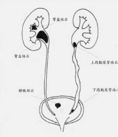 泌尿系結石