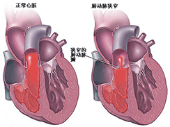 先天性心臟病