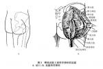 坐骨神經損傷