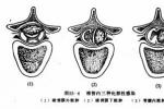 小兒硬脊膜外膿腫