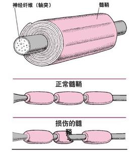 多發性硬化