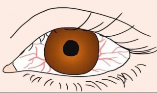 眼睛有紅血絲怎麼辦 消除的幾種方法推薦