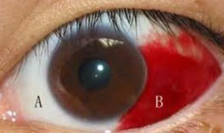 眼球出血怎麼辦 如何保護眼睛呢