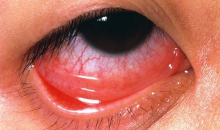 眼球充血怎麼辦 宜中西醫結合治療