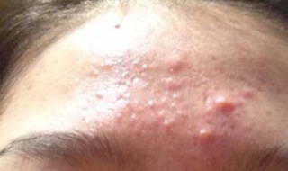 額頭上長痤瘡怎麼辦 有這麼三種消除方法