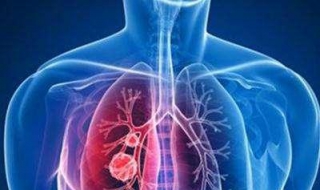 肺炎的癥狀 及其治療方法