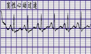 竇性心動過速怎麼辦 註意原發病的飲食宜忌