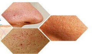 油性皮膚毛孔粗大怎麼辦 補水效果訴求量較大
