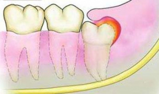 牙齦腫痛怎麼辦 時刻註意口腔衛生