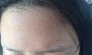 額頭上的痘痘怎麼辦 怎麼改善皮膚