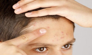 額頭上長粉刺怎麼辦 日常怎麼護理皮膚
