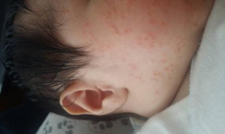 嬰兒臉上濕疹怎麼辦 選用不含激素的產品