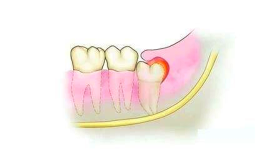 牙齦腫痛如何預防