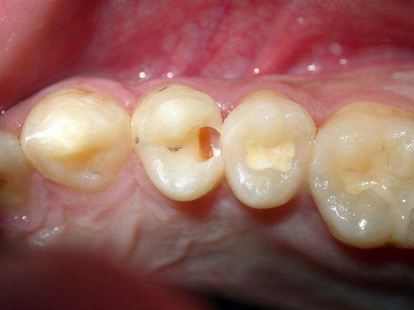 蛀牙能修復嗎